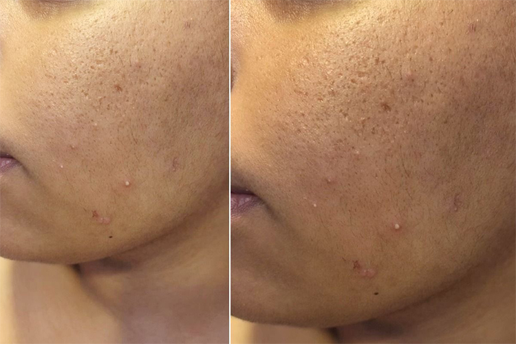 How to prevent clogged pores throughout the summer.