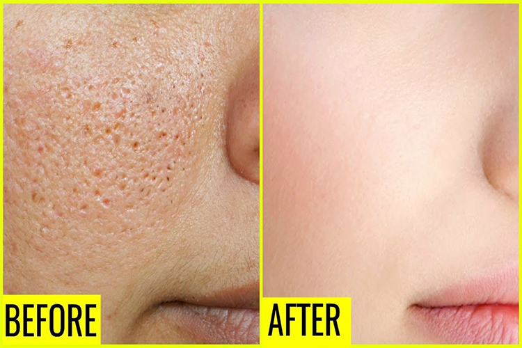 How to prevent clogged pores throughout the summer.